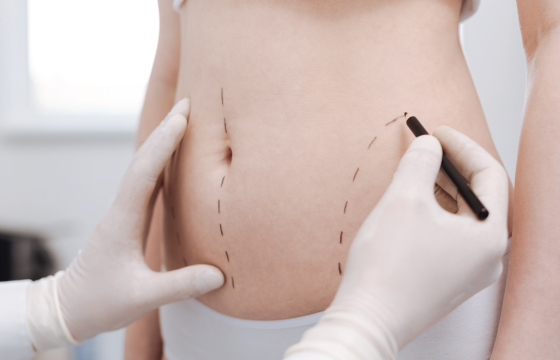 What is Liposuction