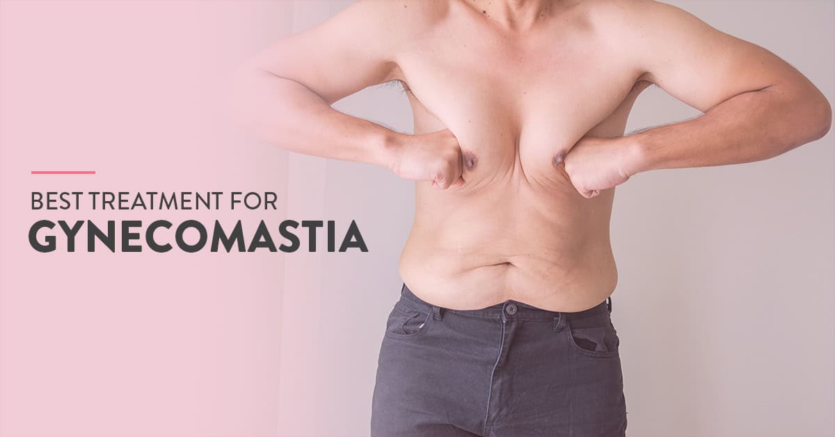 Can gynecomastia be treated with weight loss and exercise?