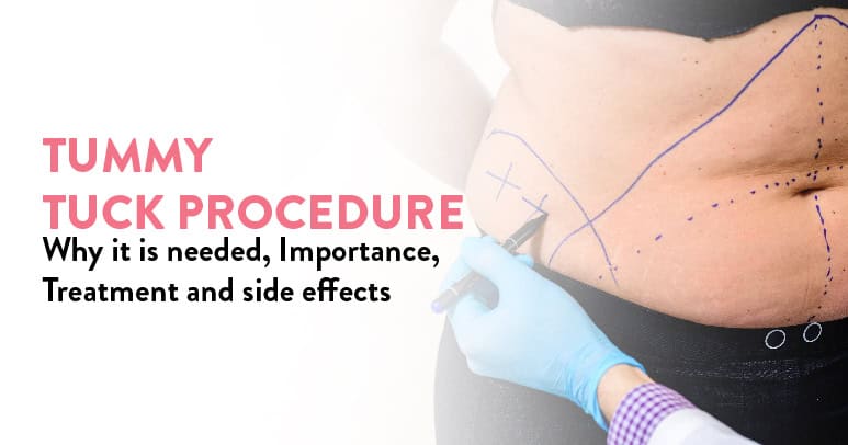 Tummy Tuck Procedure – Why it is needed, its Importance, Treatment and side effects