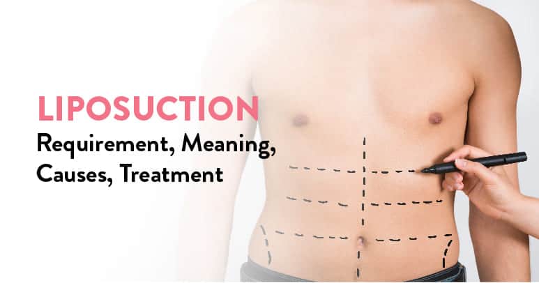 What is Liposuction ?