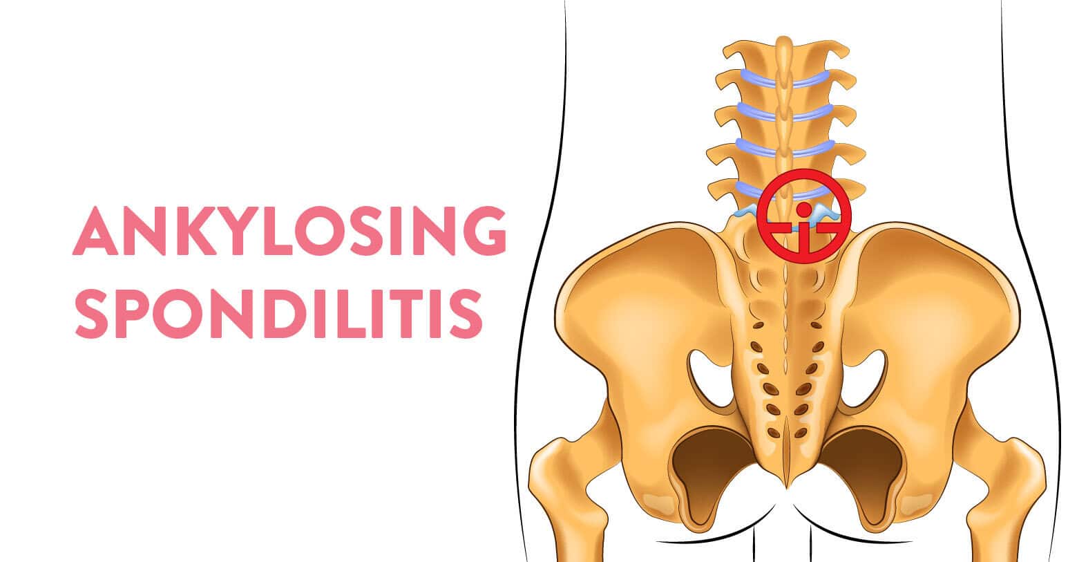 Prone to Frequent Lower Back Pain? 7 Things to Know About Ankylosing Spondylitis