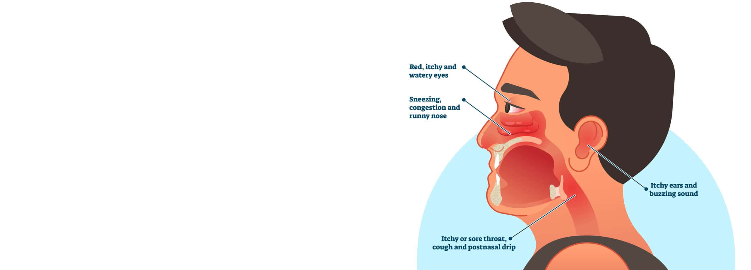 Anatomical illustration showing itchy eyes, nose, ears, and throat from allergic rhinitis