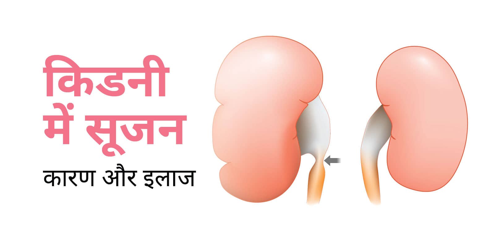 किडनी में सूजन का कारण और इलाज | Kidney Inflammation in Hindi