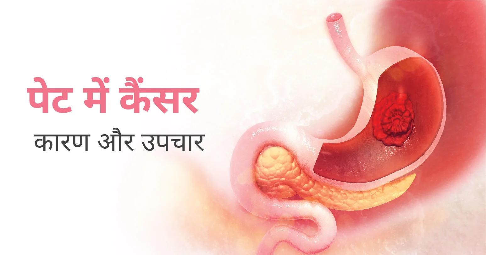 पेट में कैंसर के लक्षण, कारण और उपचार | Stomach Cancer in Hindi