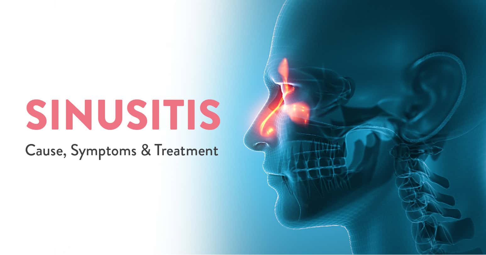 Sinusitis: Cause, Symptoms & Treatment