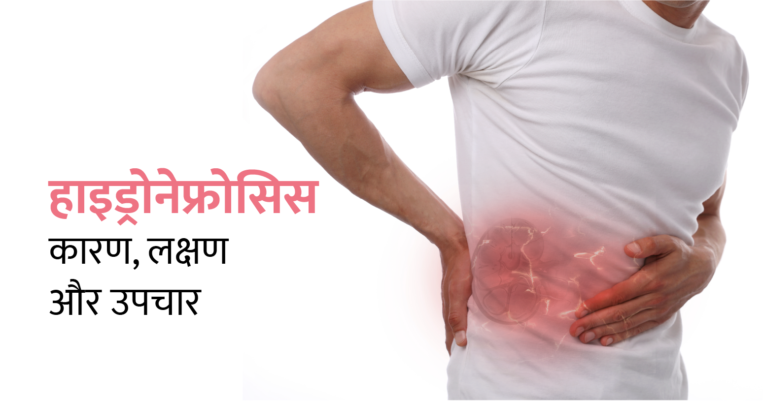हाइड्रोनेफ्रोसिस का कारण, लक्षण और उपचार 