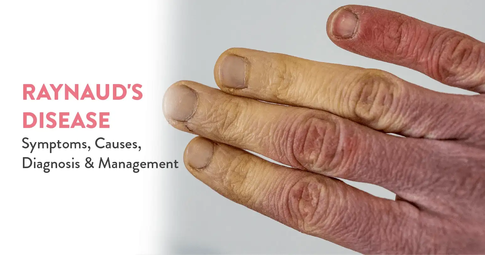 Raynaud’s Disease: Symptoms, Causes, Diagnosis, and Management
