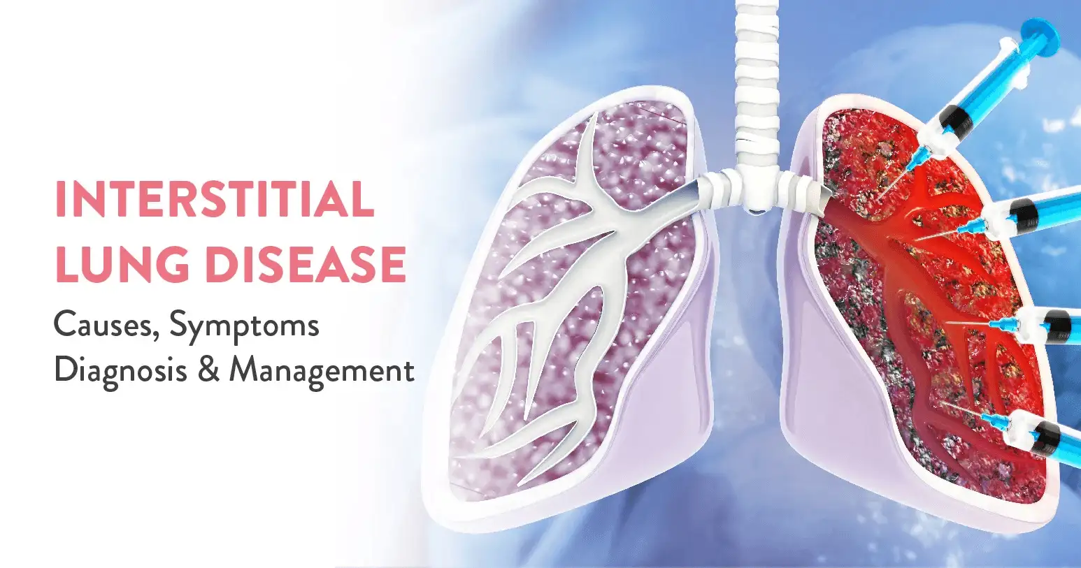 Interstitial Lung Disease: Causes, Symptoms, Diagnosis, and Management