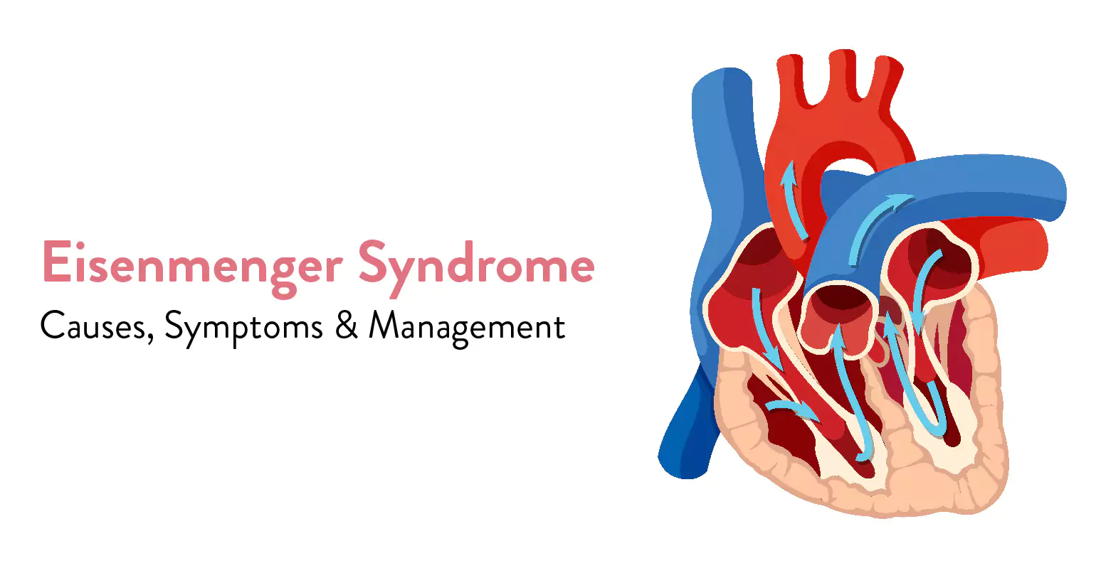 Eisenmenger Syndrome: Causes, Symptoms, Complication and Treatment