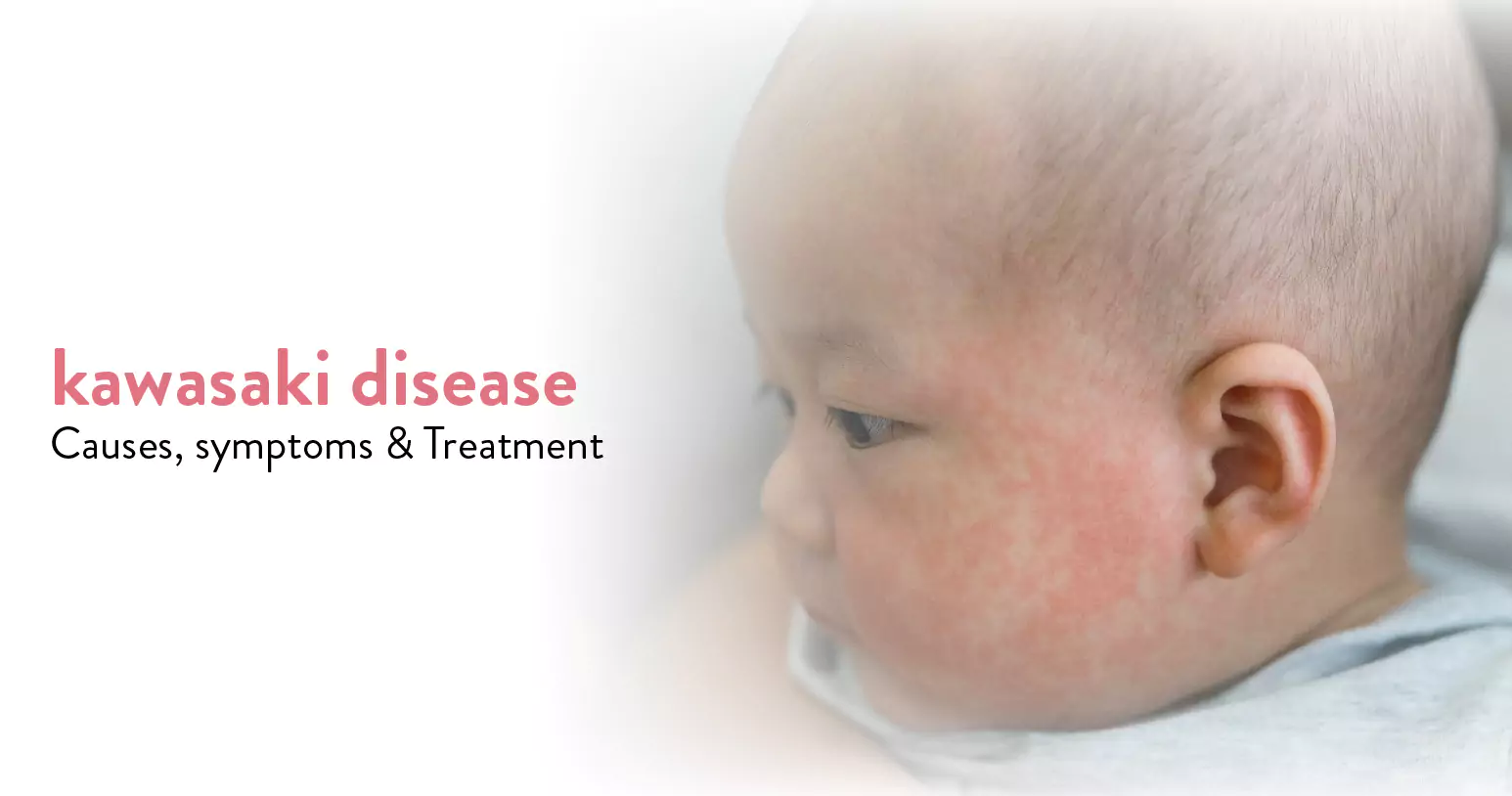 Kawasaki Disease: Causes , Symptoms & Treatment