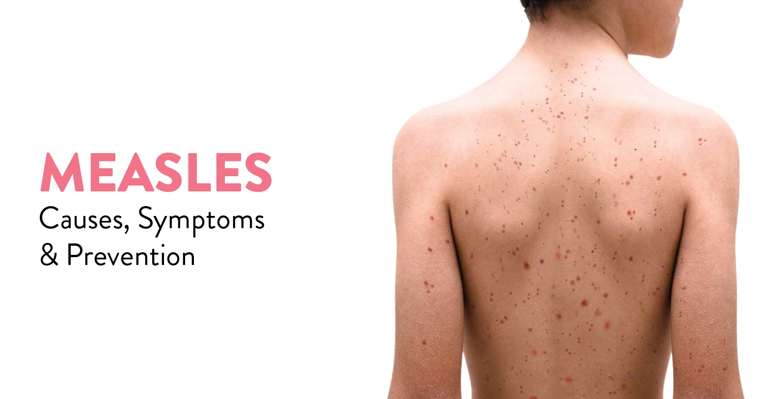 Measles: Causes, Symptoms, and Prevention