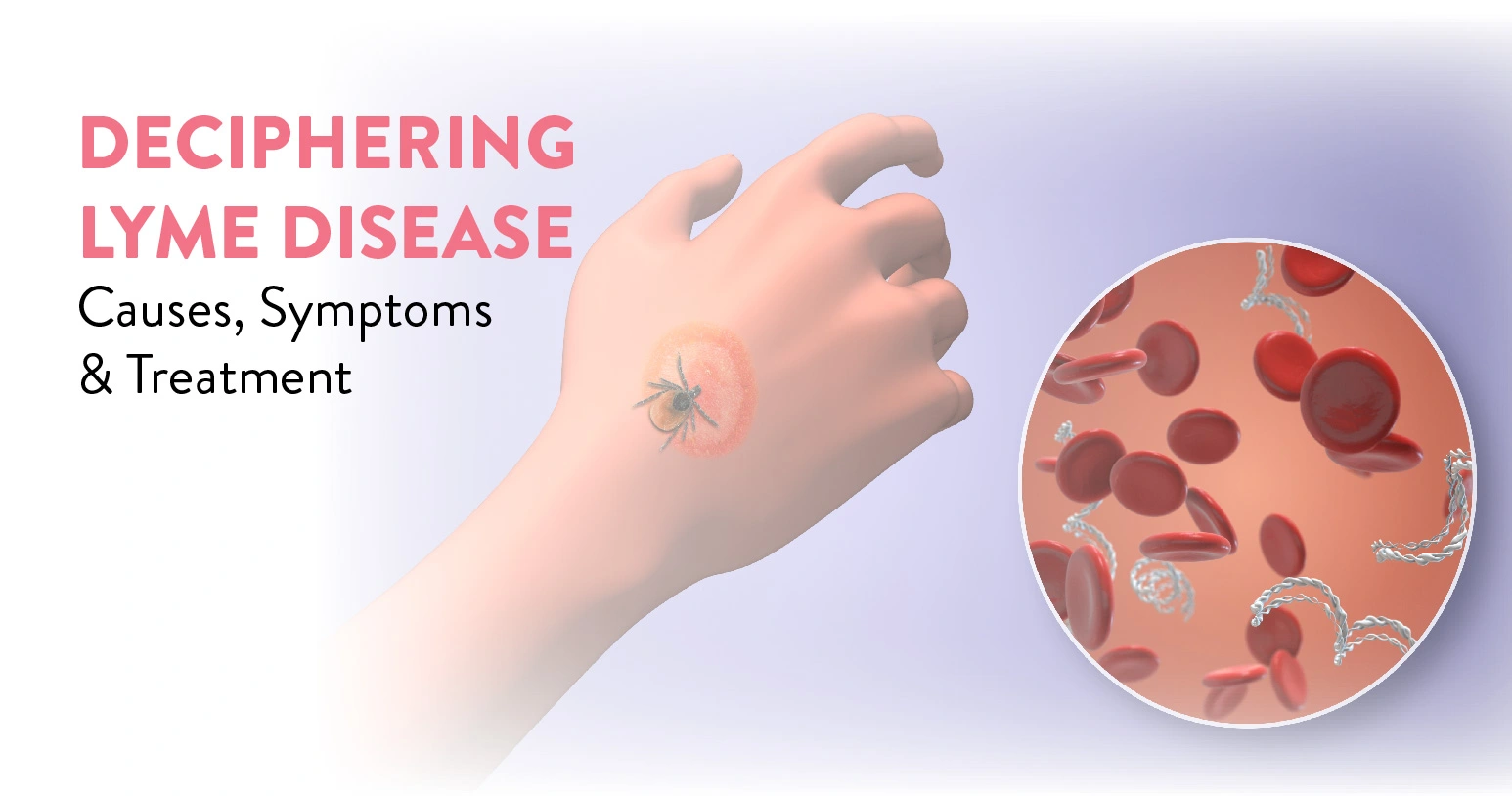 Deciphering Lyme Disease: Causes, Symptoms, and Treatment