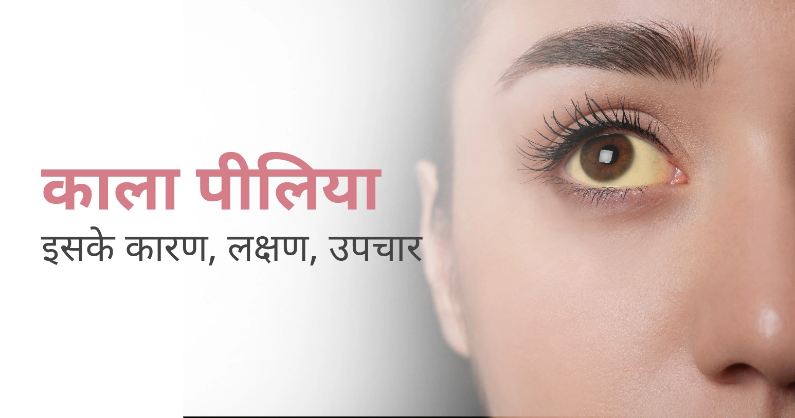 जानिए काला पीलिया क्यों होता है ? इसके कारण, लक्षण, उपचार