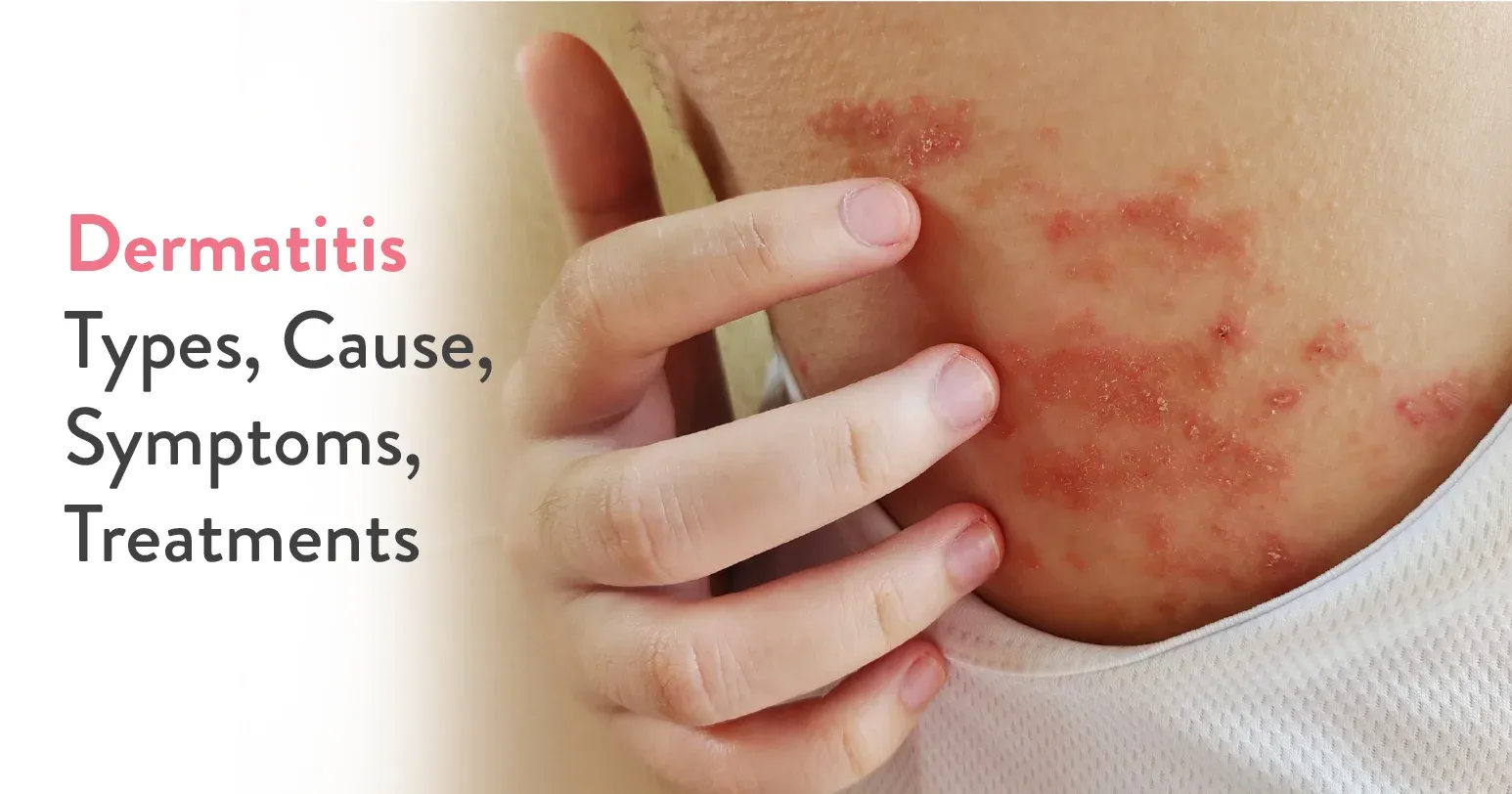 Dermatitis: Types, Causes, Symptoms & Home Remedies for Treatment