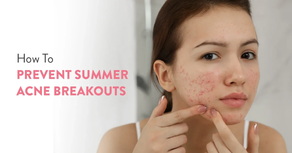 Summer Acne: Tips for Preventing Breakouts