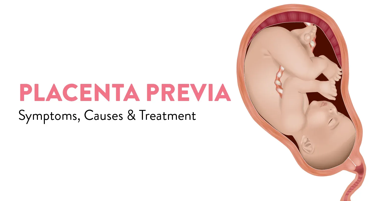 Placenta Previa: Symptoms, Causes, Complications & Treatment Options