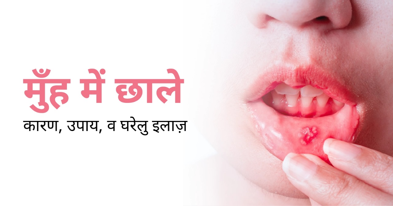 मुँह में छाले: कारण, उपाय, व घरेलु इलाज़