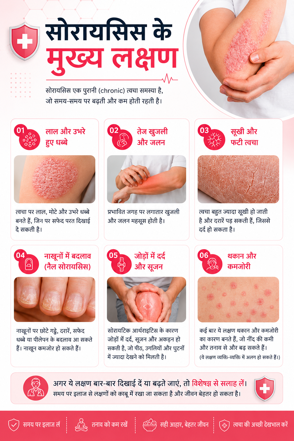 सोरायसिस लक्षण