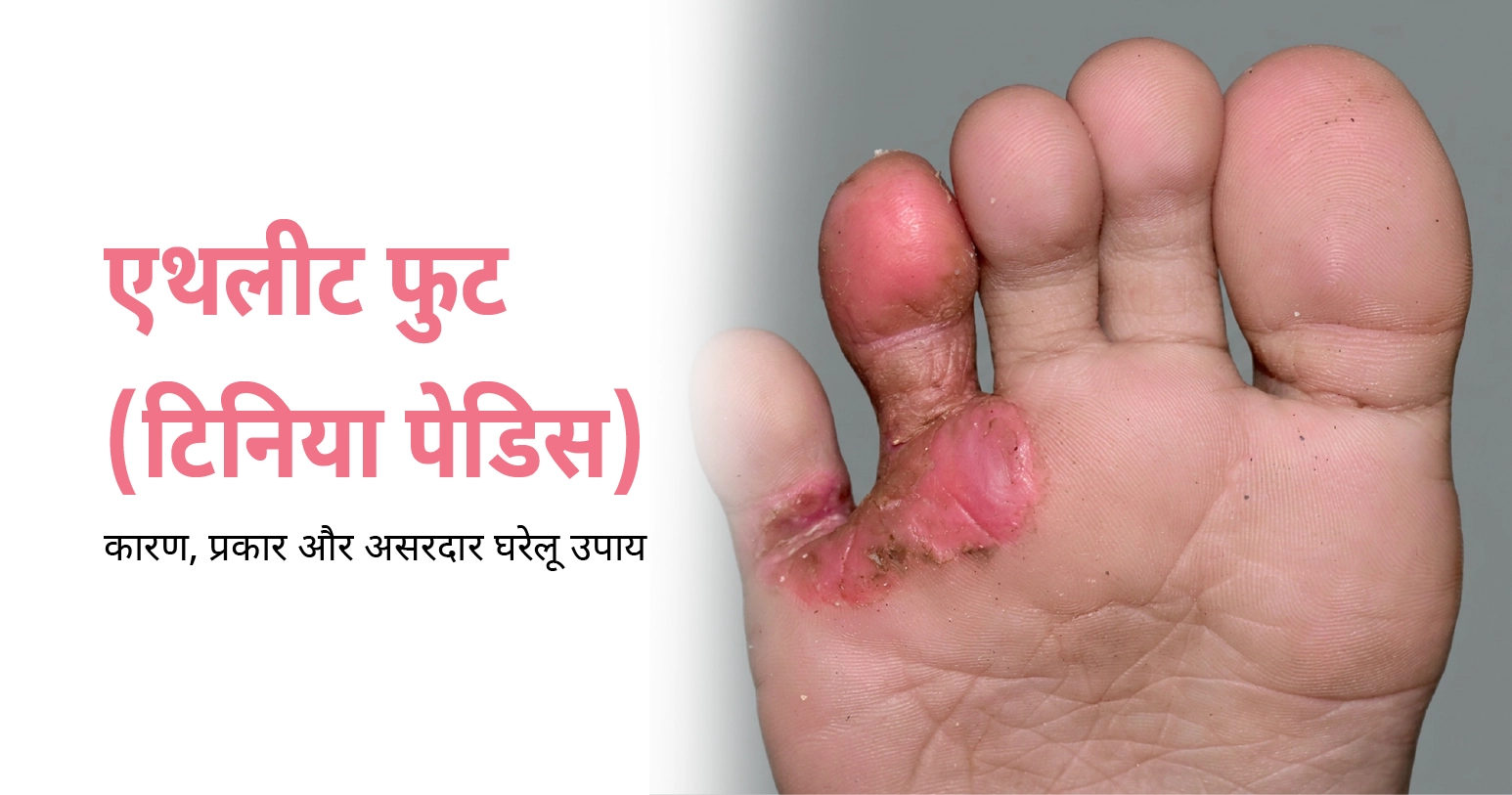 एथलीट फुट (टिनिया पेडिस): कारण, लक्षण, घरेलू उपाय और इलाज