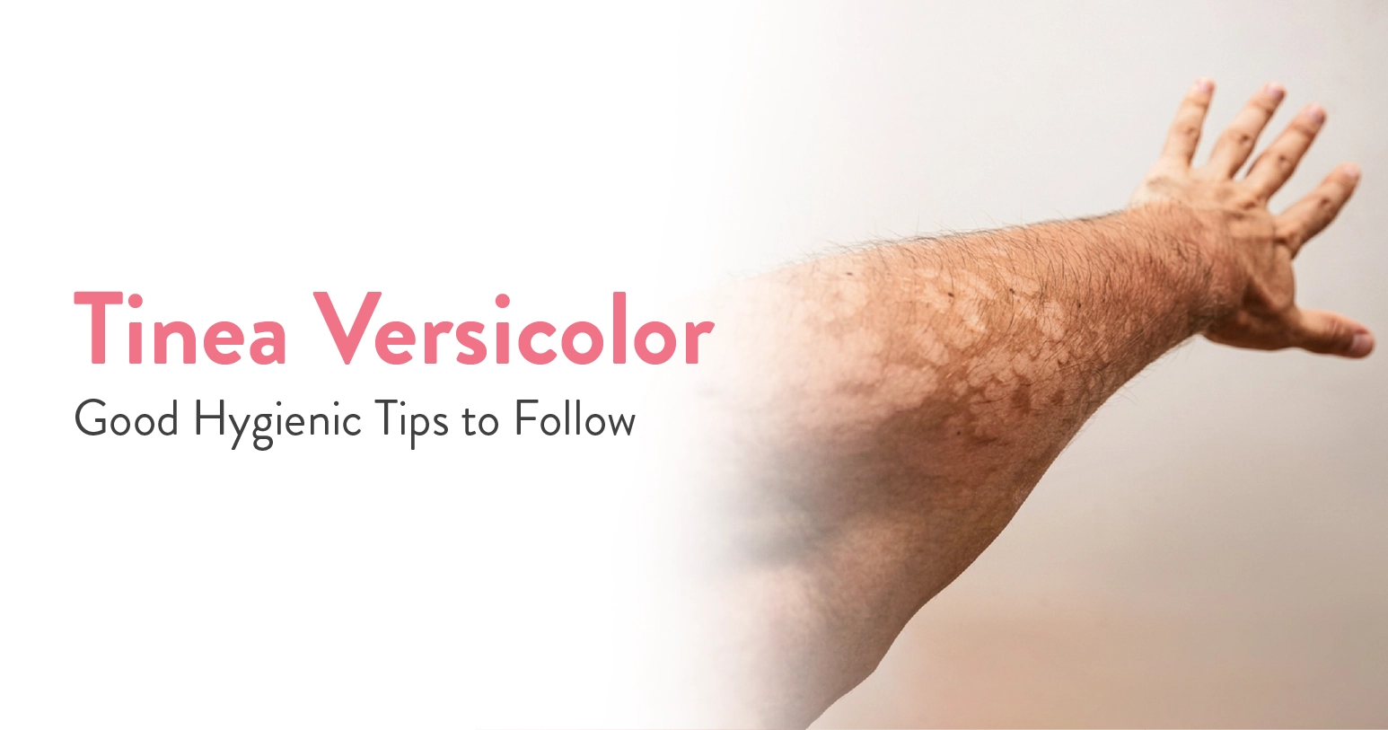 Tinea Versicolor: Symptoms, Causes, and Treatment