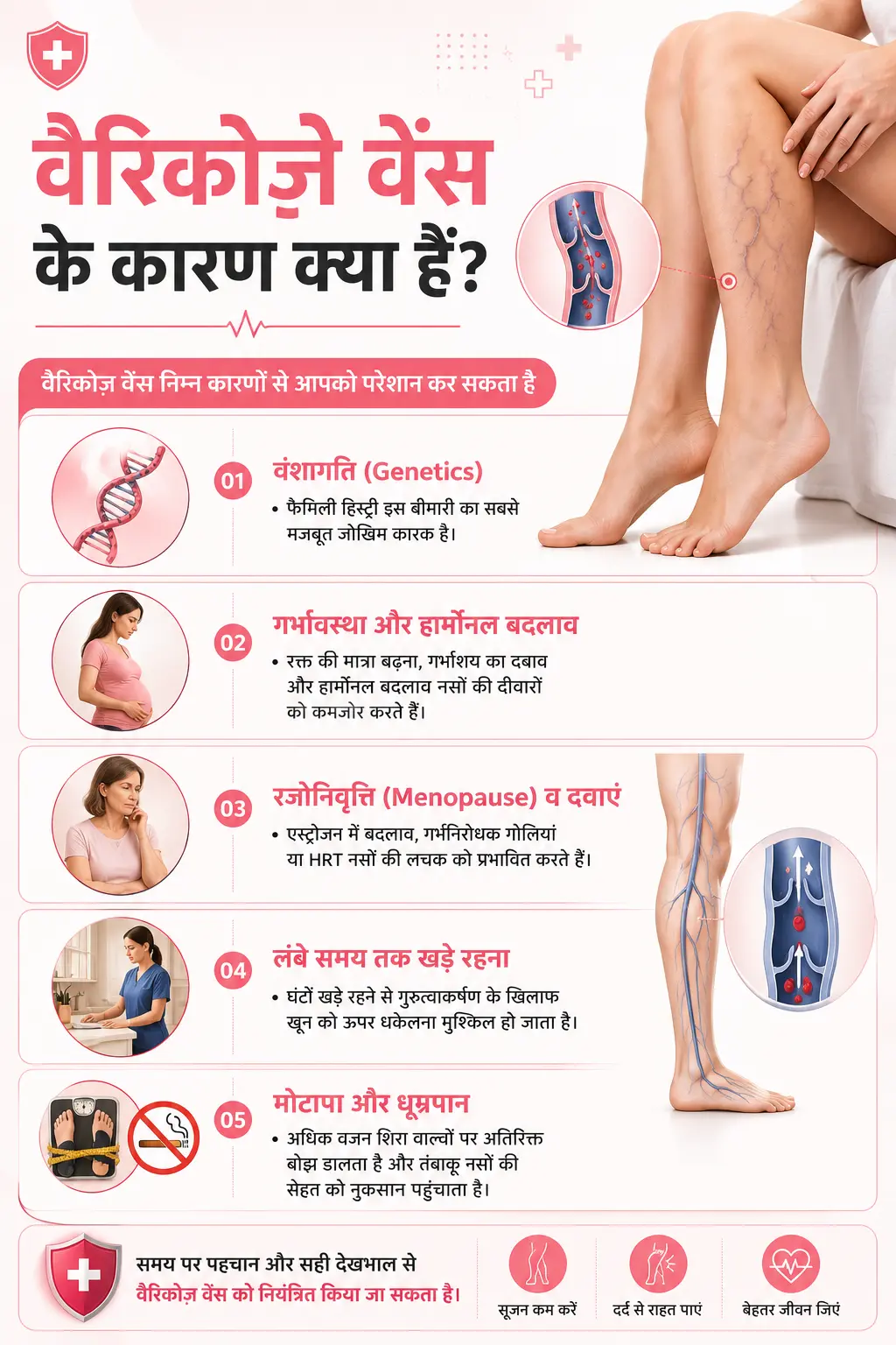Causes of Varicose veins
