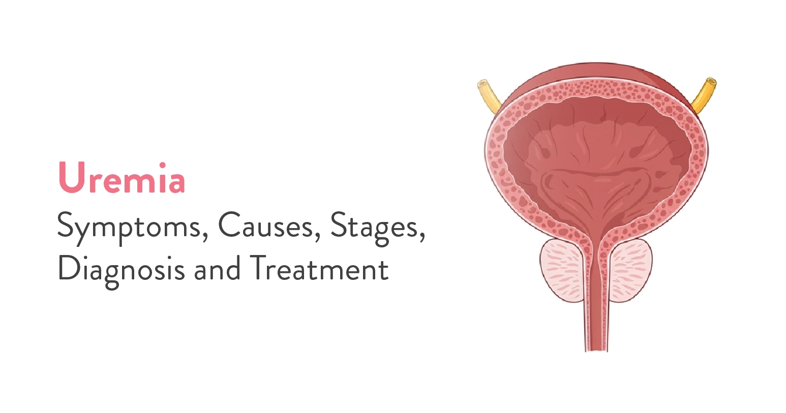 Uremia: Symptoms, Causes, Stages, Diagnosis and Treatment