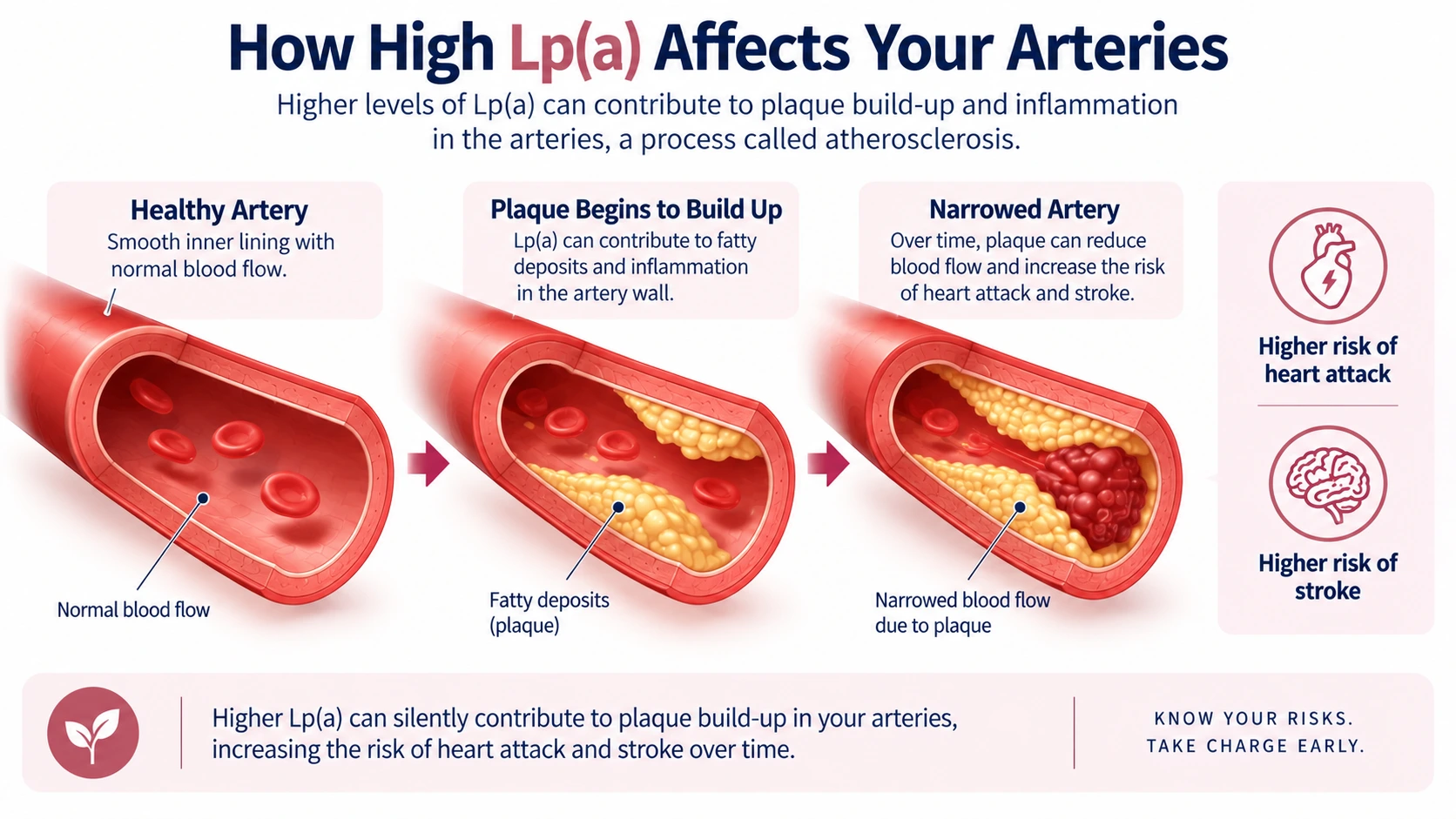 How high Lp(a) affects your arteries