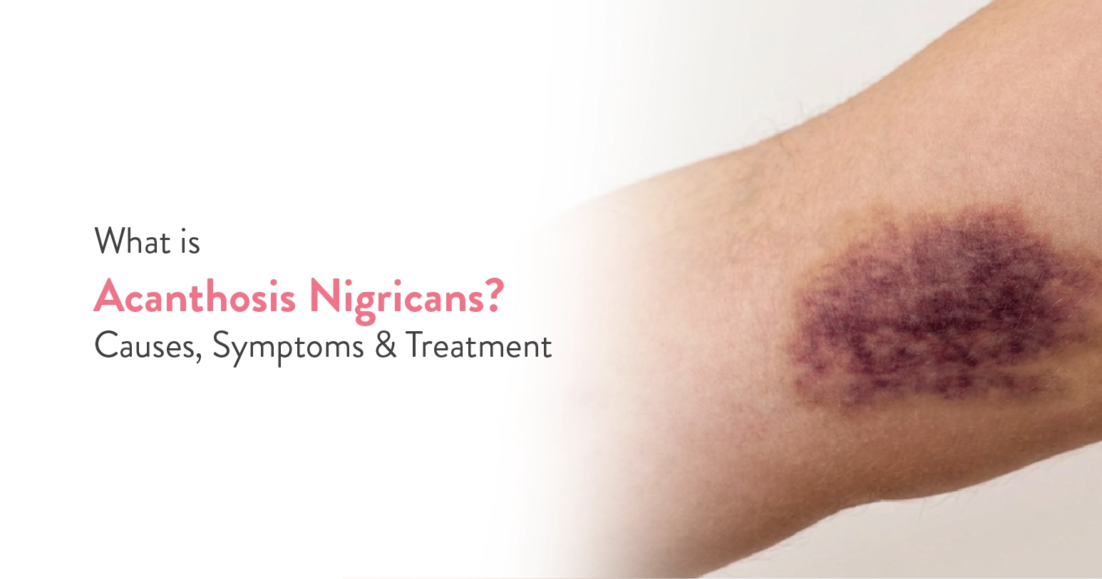 What is Acanthosis Nigricans? Causes, Symptoms & Treatment