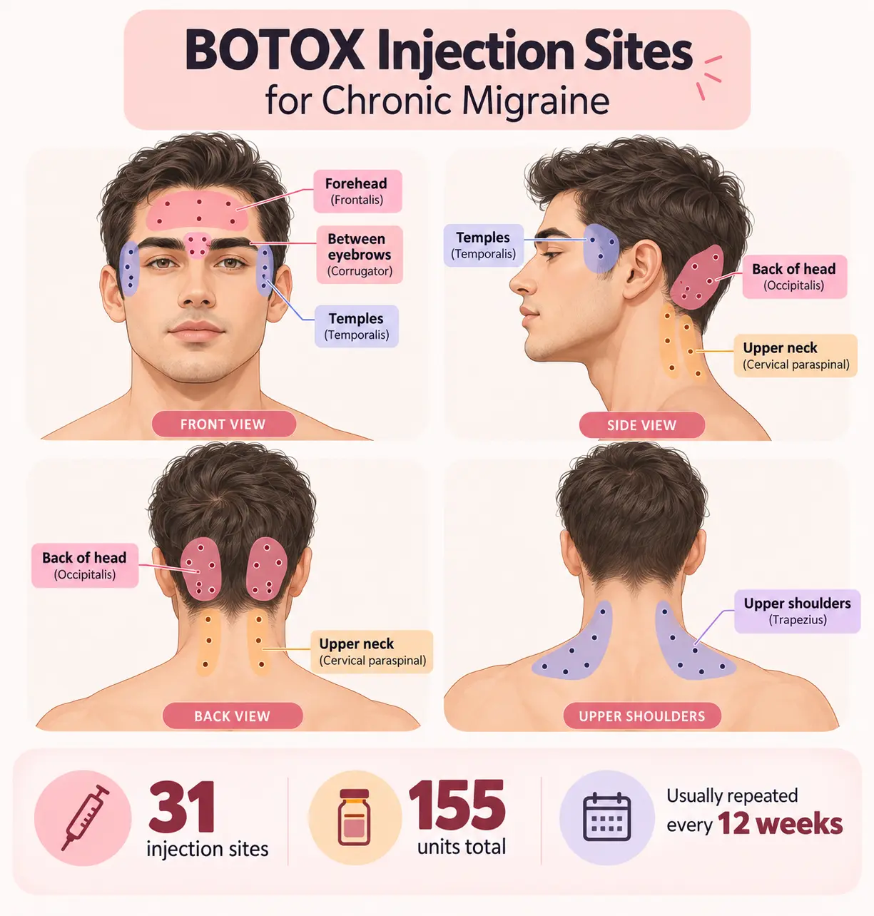 Botox injection sites for chronic migraine
