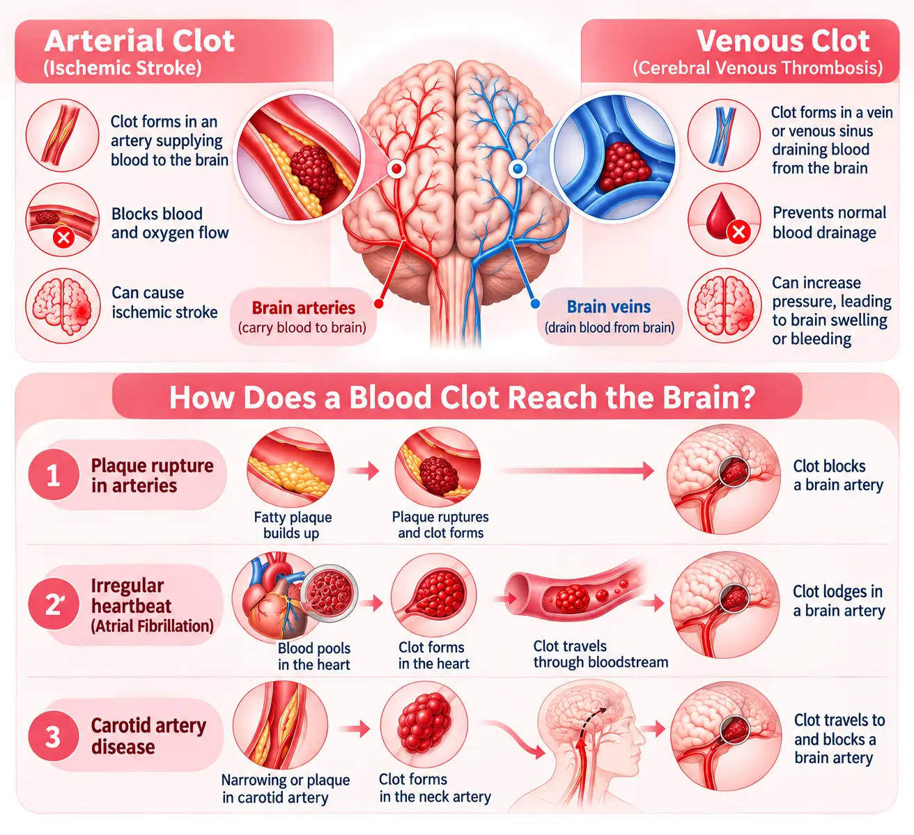 How Blood Clots Reach the Brain